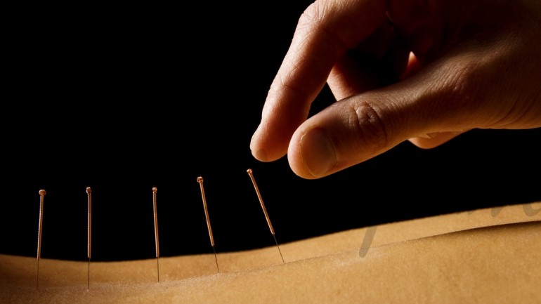 Acupuntura facial para rejuvenecer