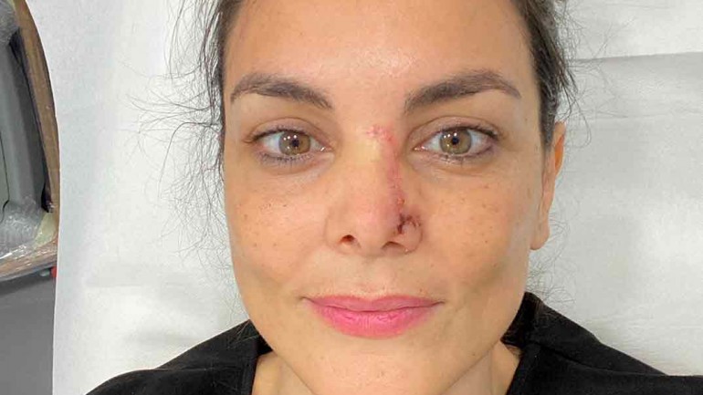 Mónica Carrillo revela que ha tenido cáncer de piel