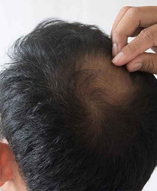 Más allá de la apariencia: cuándo preocuparse por la caída de cabello