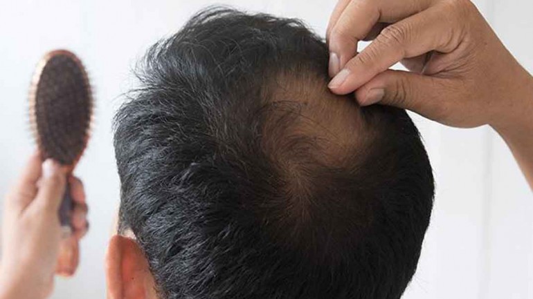 Más allá de la apariencia: cuándo preocuparse por la caída de cabello