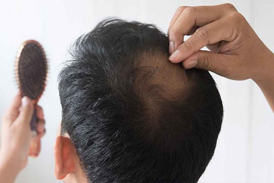 Más allá de la apariencia: cuándo preocuparse por la caída de cabello